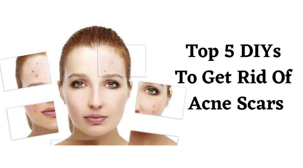 Top 5 DIYs To Get Rid Of Acne Scars
